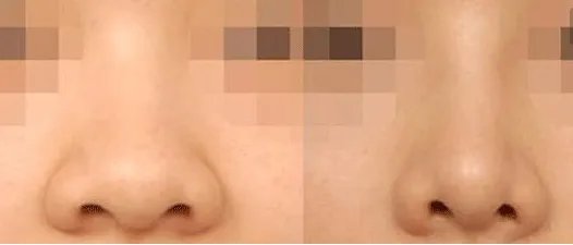鼻翼缩小前后对比图	