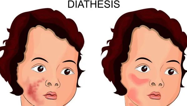 脸颊两边长痤疮怎么办