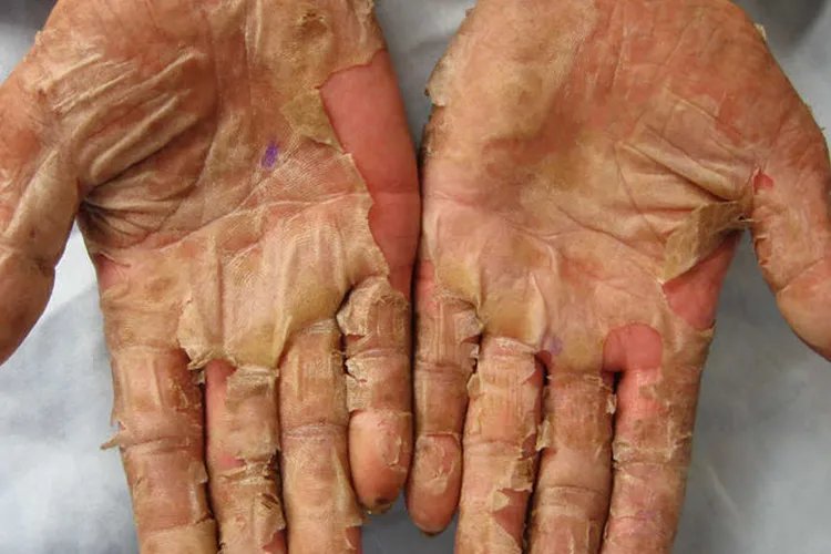 过敏性皮疹图片