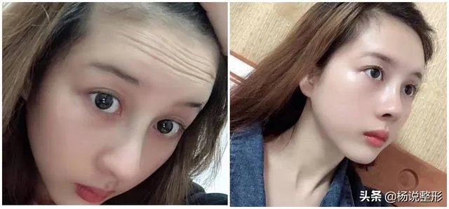 面部除皱最好的方法是什么？