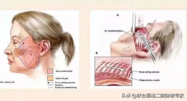 面部除皱最好的方法是什么？