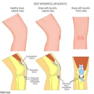 髌腱炎怎么治疗 揭秘髌腱炎的有效疗法