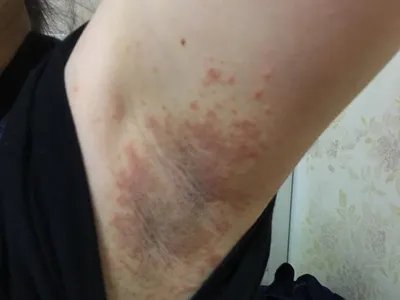 间擦疹丘疹图片