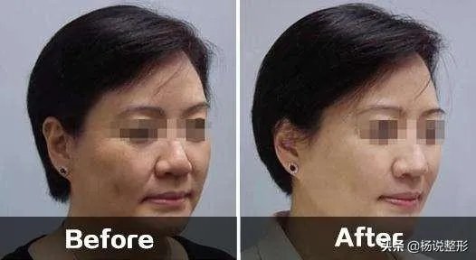 面部除皱最好的方法是什么？