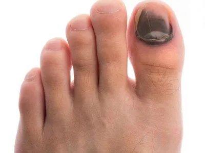 肢端雀斑痣样黑素瘤黑斑图片