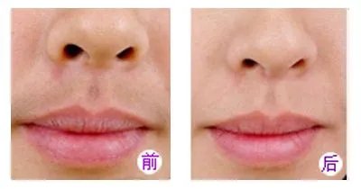 激光脱毛价格在多少