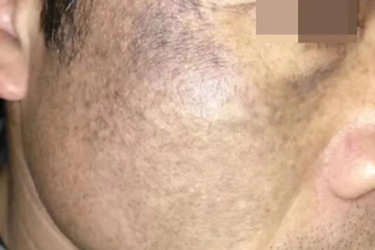 黑变病面部黑斑图片