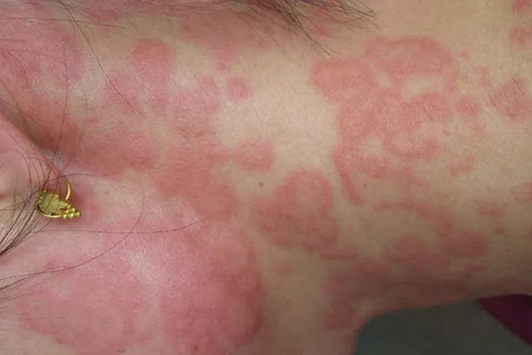 过敏性皮疹图片