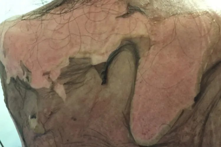 过敏性皮疹图片