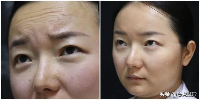 面部除皱最好的方法是什么？