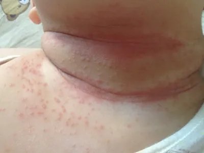 间擦疹丘疹图片