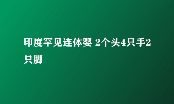 印度罕见连体婴 2个头4只手2只脚
