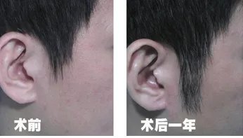 鬓角移植的步骤