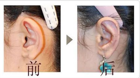 杯状耳怎么整形