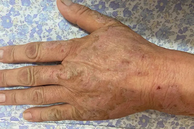 过敏性皮疹图片