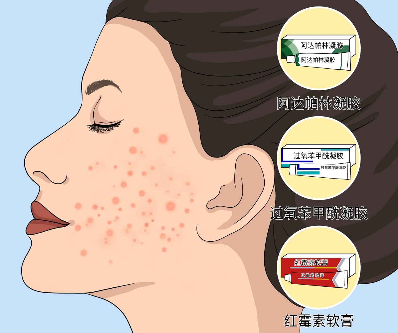 长痘痘抹什么药膏好