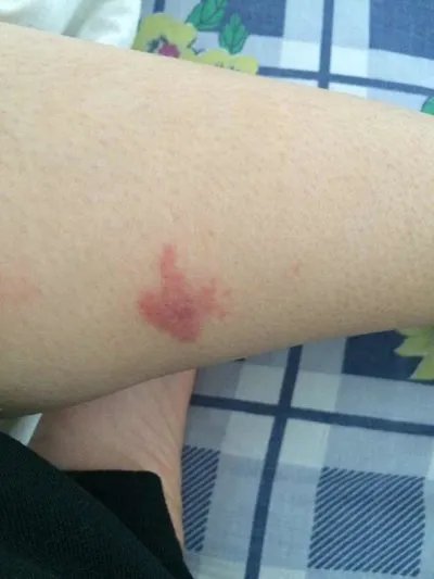 过敏性紫癜的症状表现