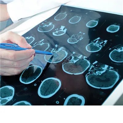 脑出血症状有哪些