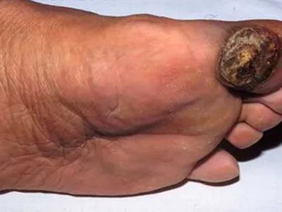 肢端雀斑痣样黑素瘤黑斑图片