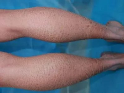 轻微鱼鳞病图片