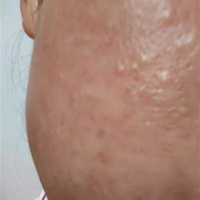 怎么样快速治疗痤疮