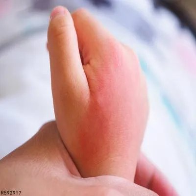 小儿接触性皮炎怎么办 详述小儿接触性皮炎的三个疗法