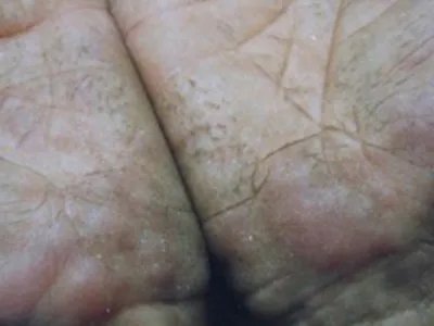 急性发热性嗜中性皮病手掌症状图片