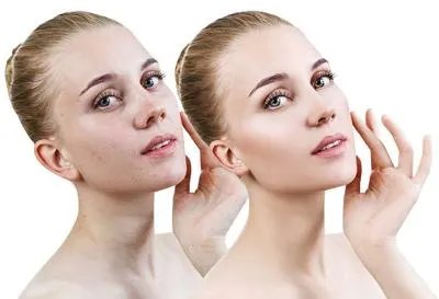 如何淡斑美白效果好