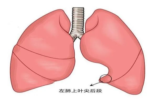 左肺上叶尖后段位置图