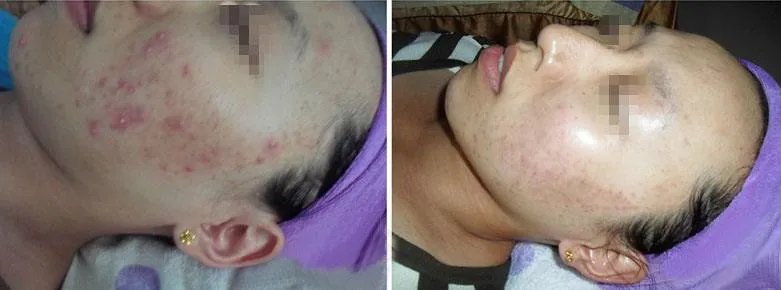 光子祛痘的价格