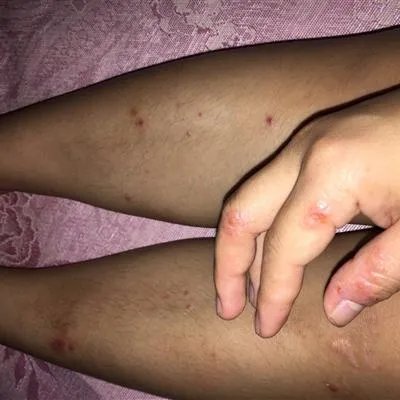 女性疥疮图片可以看出的症状有什么