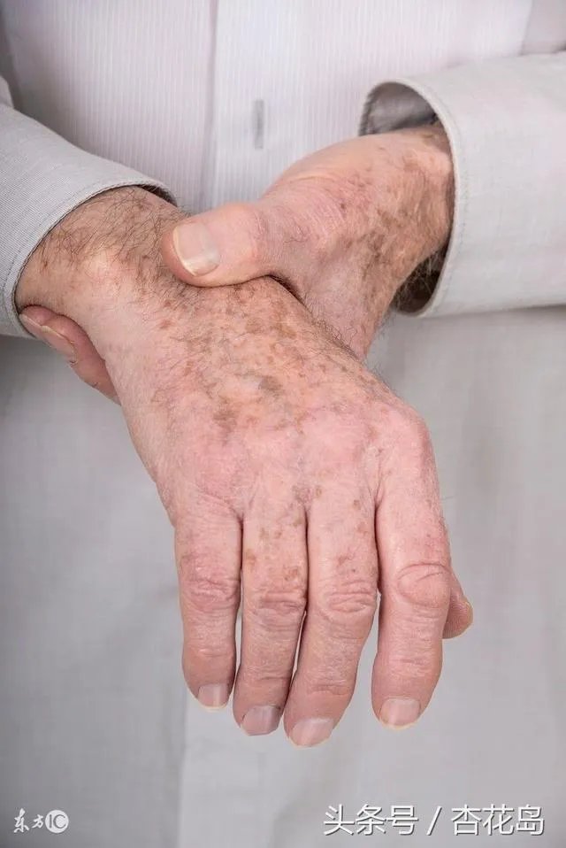 老年斑是怎么回事？