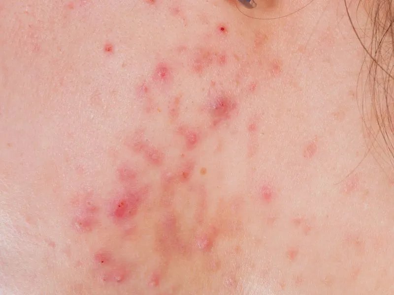 治疗痤疮色斑的方法