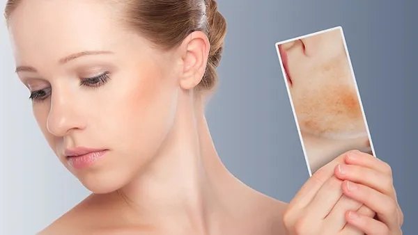 如何祛除脸上的黄褐斑