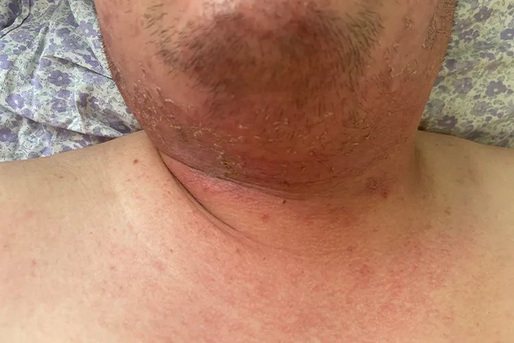 过敏性皮疹图片