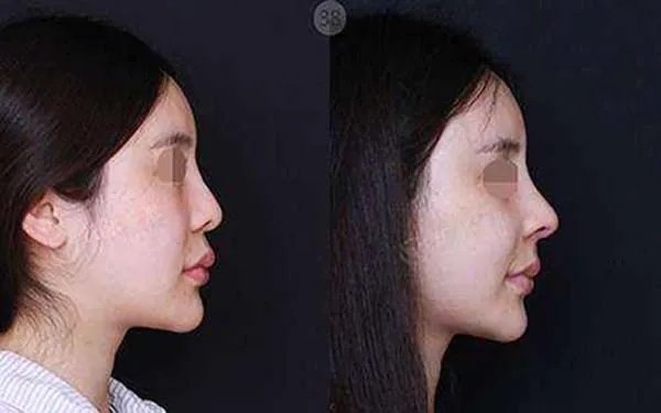 硅胶假体三段式隆鼻的介绍