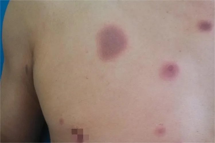 过敏性皮疹图片