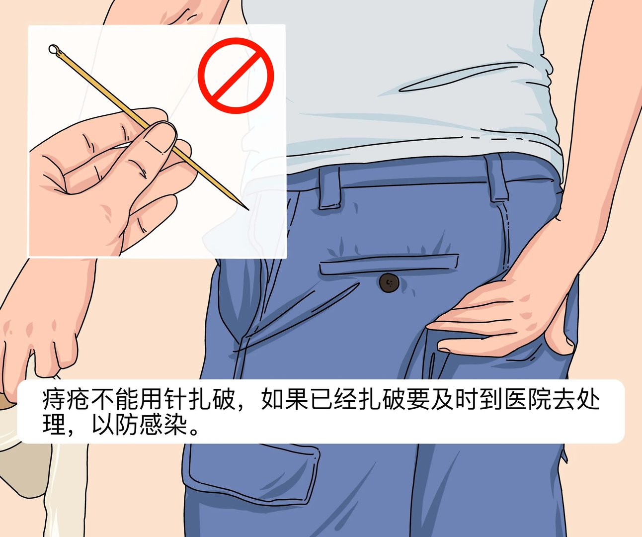 痔疮能用针扎破吗