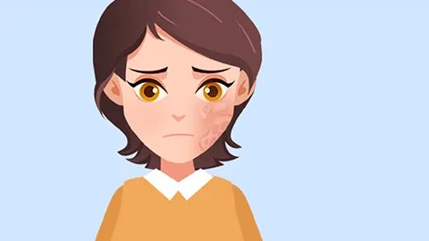 脂溢性皮炎治疗时间