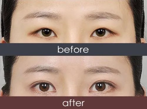 韩式三点双眼皮手术缺点有哪些？