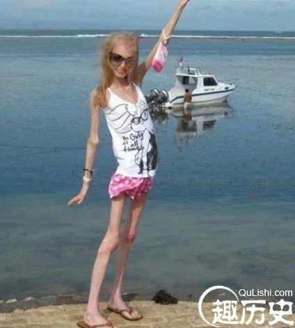 世界六大之最,全球最瘦的人,减肥过度如干尸仅20公斤