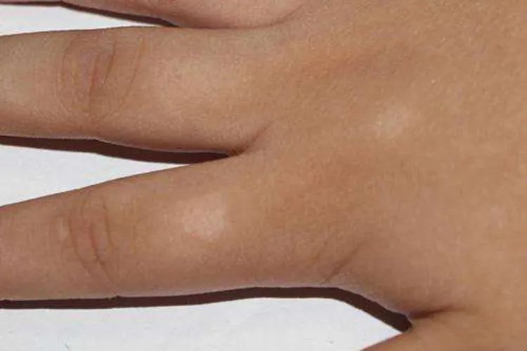 手上白斑最初期的图片