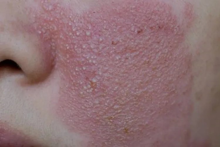 被子过敏的症状的图片