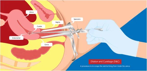 引产后的女性多久可以怀孕