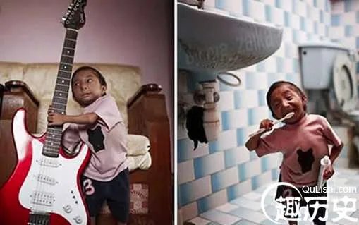 世界六大之最，全球最瘦的人，减肥过度如干尸仅20公斤