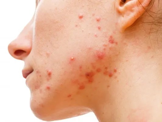痤疮原因