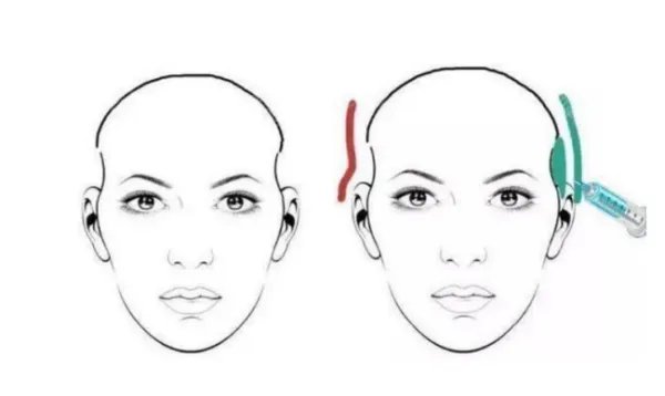 全脸脂肪填充几天消肿？究竟全脸脂肪填充多久可以恢复自然