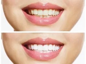 深圳齿科冷光美白价格比拼