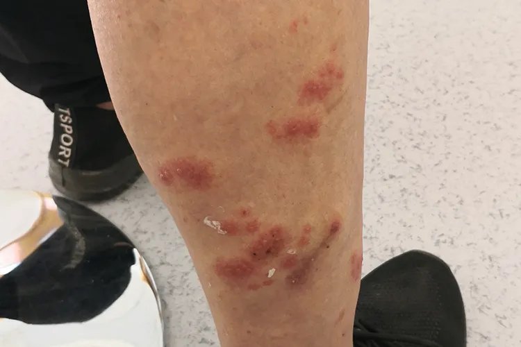 缠身龙皮肤病一般部位图片