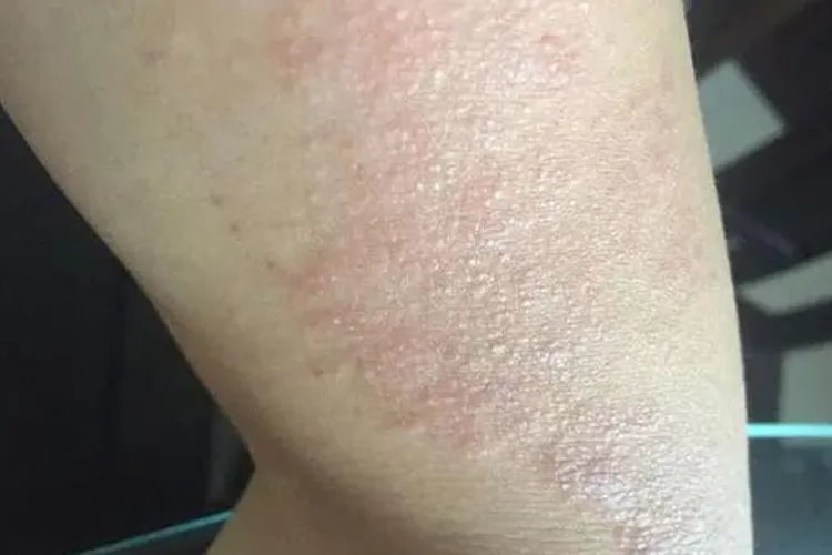 被子过敏的症状的图片